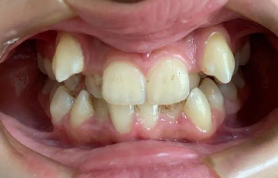 Dentes desalinhados antes da ortodontia