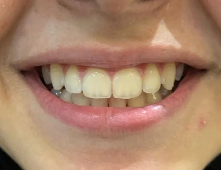Dentes alinhados após tratamento ortodôntico